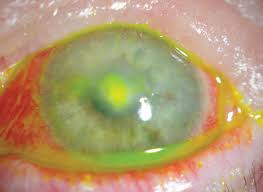 Image result for Ciliary Flush