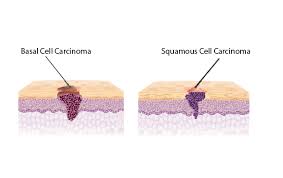 It affects people of all races, genders and ages, which is why it's absolutely critical for americans to learn about. Types Of Skin Cancer Oncobeta