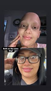 Feeling little low today.. yesterday I was told I was told I was type 1..  insulin 4x daily... monitor being fitted next week.. Dr informed me that  immunotherapy to treat my breast