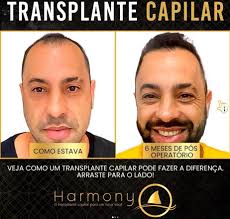 Harmony Transplante...