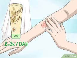 3 Ways To Get Rid Of Burn Scars - Wikihow