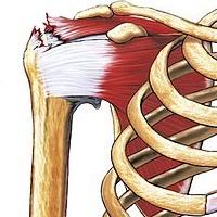 Image result for Rotator Cuff Rupture