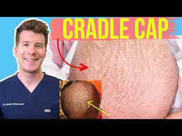 Image result for Cradle Cap