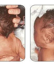 Image result for Webbed Neck