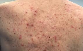Maybe you would like to learn more about one of these? Is My Skin Rash A Covid 19 Symptom