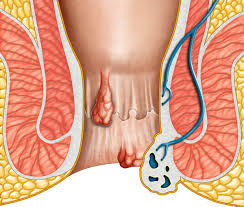 Hämorrhoiden sind geschwollene venen im rektum oder am after, die zu jucken beginnen und schmerzhaft werden. Hamorrhoiden Symptome Typische Anzeichen Erkennen Was Tun