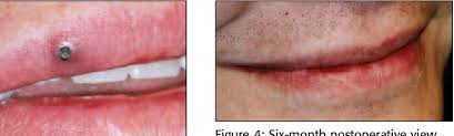 These are also called senile angioma, campbell de morgan spots, or de morgan venous lakes: Senile Hemangioma Of Lip Semantic Scholar