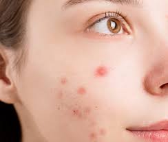 Waarom een 'wijnvlek' of litteken al snel tot onterechte afwijzing kan  leiden