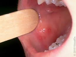 Image result for Hand foot and mouth disease HFMD roof of mouth