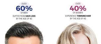 Hair loss in women over 50 is a common problem. Hair Loss Information Types Of Baldness Hr23