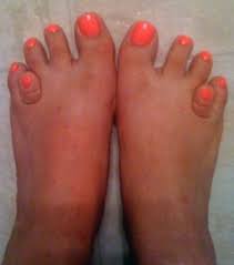 12 fotos de las peores uñas de los pies en el mundo. Resultat De Recherche D Images Pour Pieds Moches Moches Feos Del Mundo Feos