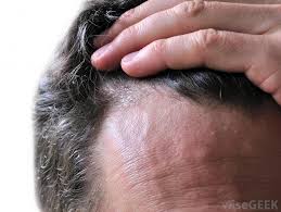Why dandruff is bad for your hair. What Are The Different Types Of Dry Skin Rashes