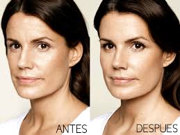 Entre 200 y 250 euros por infiltración. Botox Eliminar Arrugas De Expresion Clinicas Vitaluz Sevilla