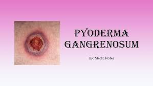 Image result for Pyoderma Gangrenosum