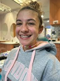 Trust the process #braces #bracesoff #bracesjourney #trusttheprocess #deaf