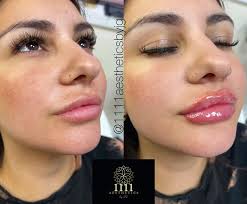 PLUMP it Up!!💋💉 Full lips for these lippies! Swelling does go down  minimally for just the right size!! 💋💋😮‍💨🔥 Message me for any  questions, 1111 Aesthetics by JG #SummerSale #Fulllips!