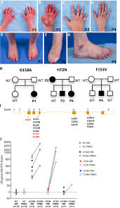 Tonton lara aishah full episod. Frontiers Case Report Novel Savi Causing Variants In Sting1 Expand The Clinical Disease Spectrum And Suggest A Refined Model Of Sting Activation Immunology
