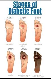 Image result for IDSA Diabetic Foot Wound Classification
