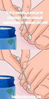 как правильно брить зону бикини чтобы не было раздражения Eti 6 Moshnyh Sredstv Ustranyat Dazhe Samyj Zapushennyj Gribok Nogtej Health Fitness Health Natural Medicine