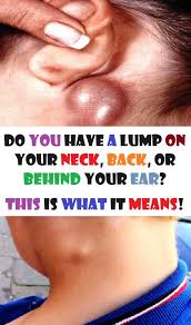 Do You Have A Lump On Your Neck Back Or Behind Your Ear This Is What It Means Skin Bumps Lump Behind Ear Ear