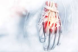 Die erkrankung ist ideal, denn sie lässt sich nur schwer nachweisen. Sehnenscheidenentzundung Der Hand Symptome Ursachen Therapie Ubungen Gelenk Klinik De