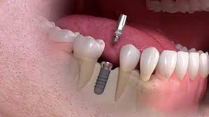 If they are done properly, they look natural. Pain In Surrounding Teeth After Dental Implant Teethwalls