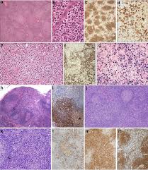These include skin rashes, joint pain, and some. Session 4 1 Angioimmunoblastic T Cell Lymphoma And Related Lesions Download Scientific Diagram