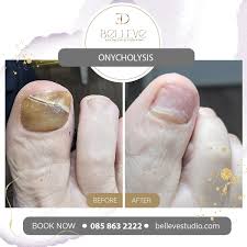 Image result for Onycholysis feet