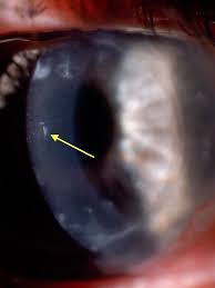 Image result for lesion sclera