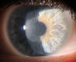 Crstg | Europe Edition | Corneal Haze After Prk Enhancement Of Prior Lasik