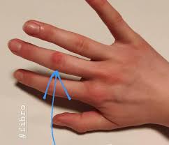 One thing i did realize is that, if you somewhat 'lightly' push on the orange spot in another direction, it tends to move. Do You Guys Have These Kind Of Spots Too All Over Hands And Feet And If So What To Do About Them Bc They Hurt Like Fibromyalgia