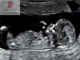 Salud Prenatal S L P Importante Ultrasonido 11 14 Semanas Facebook