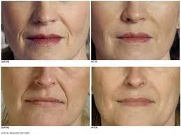 Do fillers age your face? What about when they wear off?