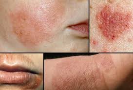 Image result for Atopic eczema atopic dermatitis