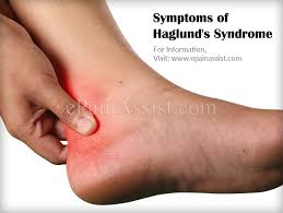 Symptoms Of Haglund S Syndrome Achilles Tendonitis Insertional Achilles Tendonitis Achilles Tendonitis Symptoms