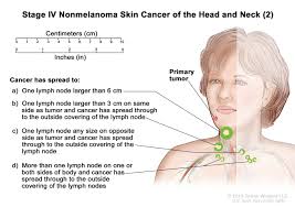 It may come and go at first, but over time it can become constant. Skin Cancer Types Symptoms Information Dana Farber Cancer Institute Boston Ma