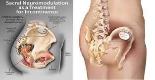 Image result for Fecal Incontinence
