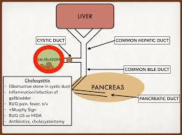 I am 36, and fairly overweight in a sedentary job and very moderate drinker. Gallbladder Cholelithiasis Vs Cholecystitis Vs Cholangitis Vs Choledocholithiasis Austin Kosier Ezmed