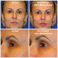 Naturliche Gesichtsverjungung Durch Hyaluronsaure Medical Aesthetics