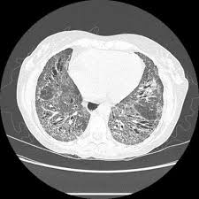 Scleroderma Pulmonary Manifestations Radiology Reference Article Radiopaedia Org
