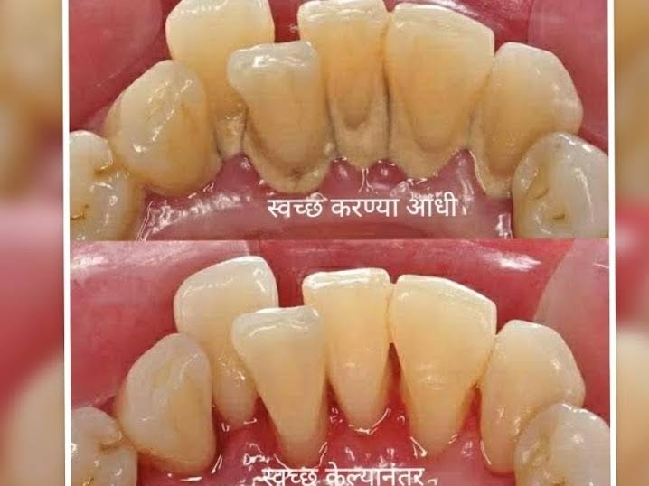 Teeth Cleaning ,Scaling And Polishing product image