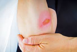 Authoritative facts from dermnet new zealand. How To Treat Burns Symptoms Causes Types First Aid
