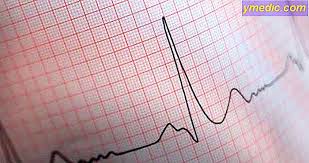 Kardiocentrum kardiologie na bulovce, s.r.o. Elektrokardiogram Ekg
