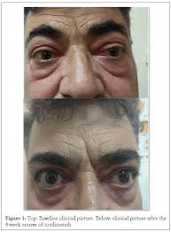 A Case of Severe Thyroid Eye Disease Treated with Tocilizumab