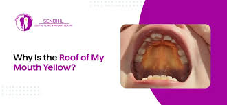 Image result for oral thrush symptoms roof of the mouth