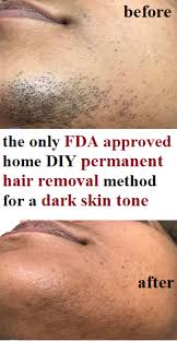 Permanent Facial Hair Removal For Women Permanent Hair Removal Diy Hair Removal Permanent Permanent Hair Removal Diy Permanent Facial Hair Removal