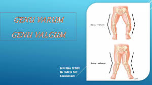 Image result for Genu Varum