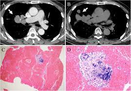 One report notes a case of systemic sarcoidosis that mimicked the symptoms and metastatic spread of cancer. Delayed Diagnosis Of Lung Cancer Due To Misdiagnosis As Worsening Of Sarcoidosis A Case Report Bmc Pulmonary Medicine Full Text