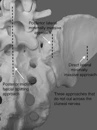 A317803 1 En 7 Fig10 Html Jpg Sacroiliac Joint Sacroiliac Spinal Surgery