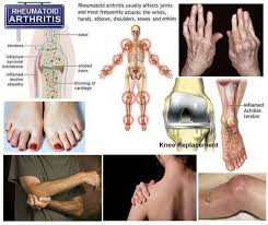 Whenever We See The Ending Itis We Know We Are Talking About Inflammation Keep Your Immune Sys Rheumatoid Arthritis Arthritis Natural Remedies For Arthritis